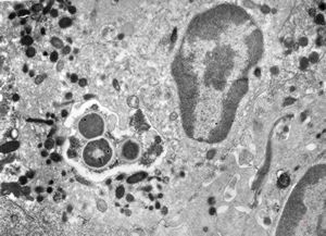 M,44y. | ulcus penis - phagocytosed microbes M,44y. | ulcus penis - phagocytosed microbes